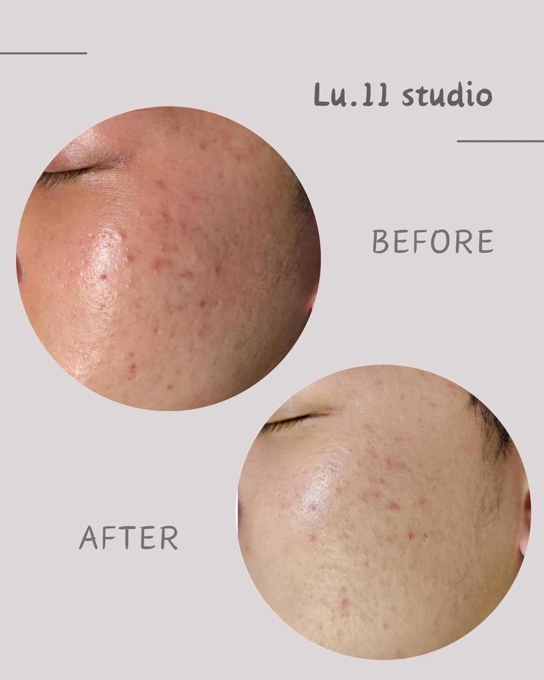 液態飛梭化學煥膚示意